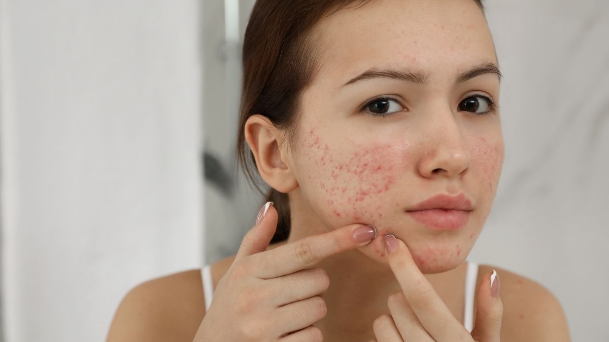 How MedExpress Acne Treatments Help Clear Stubborn Breakouts